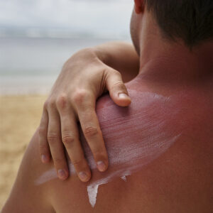 sunscreen on sunburnt skin of man's back